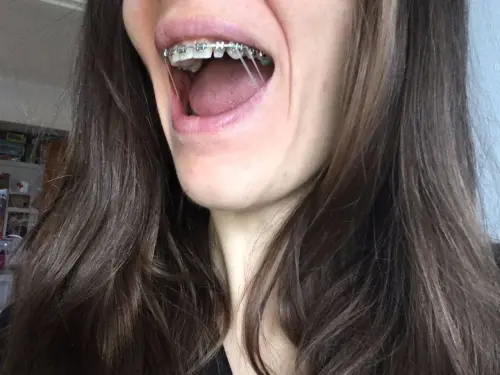 Braces Tightening Appointments: What to Expect With Elastics Braces Tightening Appointments: What to Expect With Elastics