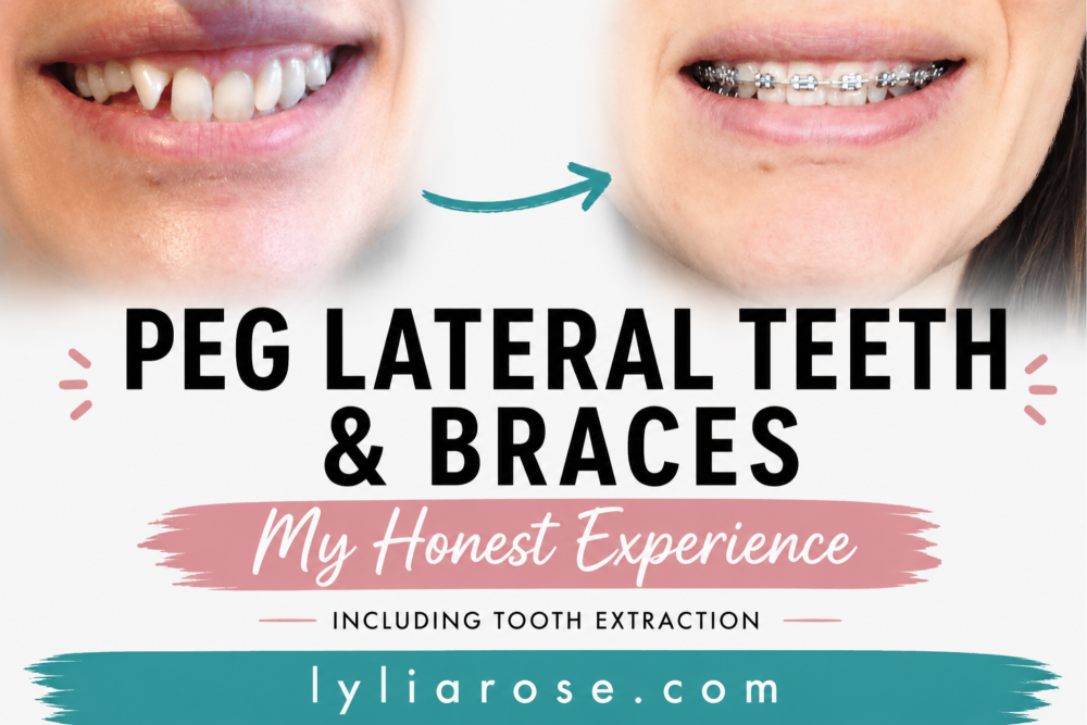 Peg Lateral Teeth, Braces & Extraction My Honest Experience Peg Lateral Teeth, Braces & Extraction My Honest Experience