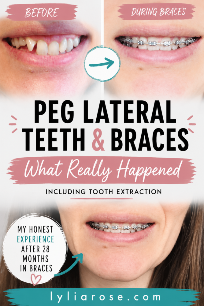 Peg Lateral Teeth, Braces & Extraction My Honest Experience (1) Peg Lateral Teeth, Braces & Extraction My Honest Experience (1)