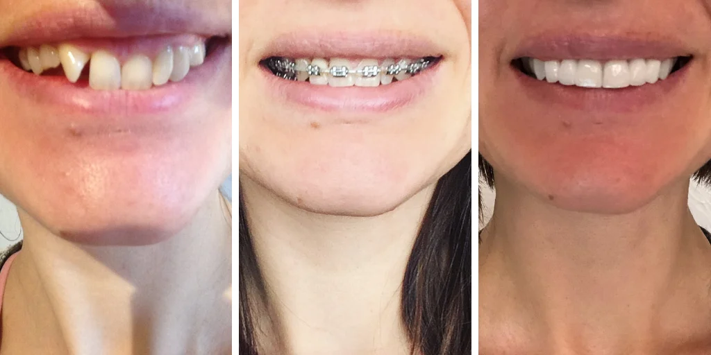My peg lateral tooth before braces, during treatment and after treatment. My peg lateral tooth before braces, during treatment and after treatment.