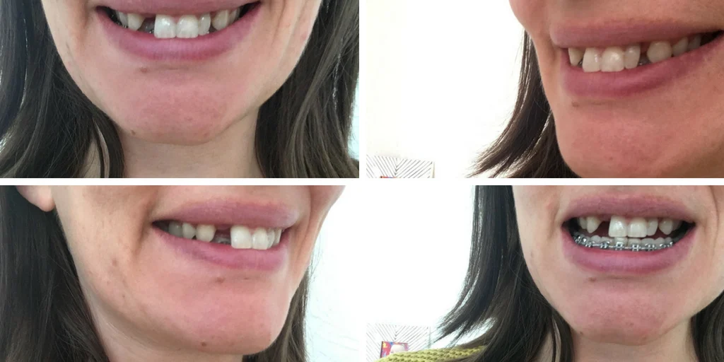 My top brace removed. The peg tooth is visible beside my front tooth, with a gap left ready for restorative treatment. My top brace removed. The peg tooth is visible beside my front tooth, with a gap left ready for restorative treatment.