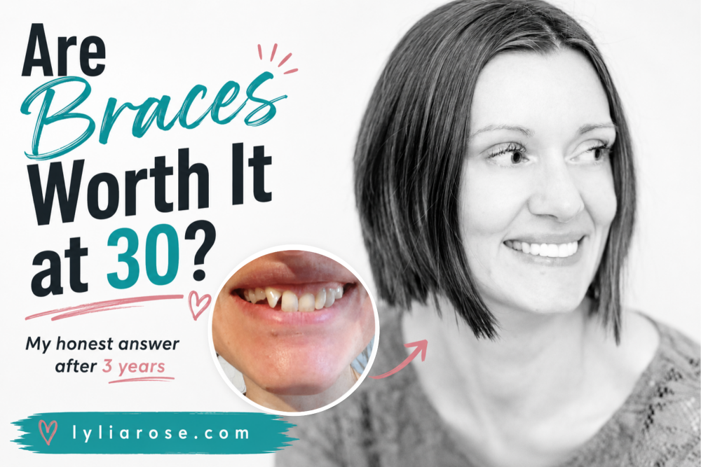 Are Braces Worth It at 30 My Honest Answer, Before and After, and Costs (2)