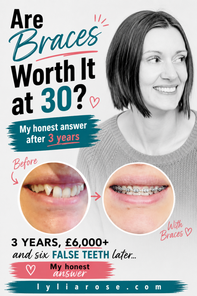Are Braces Worth It at 30 My Honest Answer, Before and After, and Costs Are Braces Worth It at 30 My Honest Answer, Before and After, and Costs