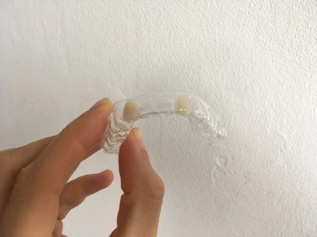 Essix retainer with two false teeth Essix retainer with two false teeth