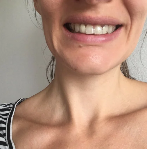 Wearing Essix retainer with two false teeth to cover missing teeth gaps Wearing Essix retainer with two false teeth to cover missing teeth gaps