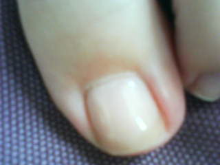 nail reconstruction
