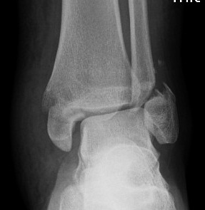 Ankle fracture preop