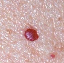 Common skin growth that can appear on most areas of your body, the broken blood vessel inside the cherry angioma give the reddish appearence. Some may be smooth with your skin while others may be slightly raised. It usually takes one treatment of advanced electrolysis to clear although deeper coloured lesions may take more then one session, however there will be an improvement after one session.