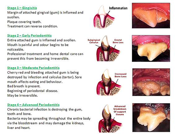 4 Stages of Periodontal Disease