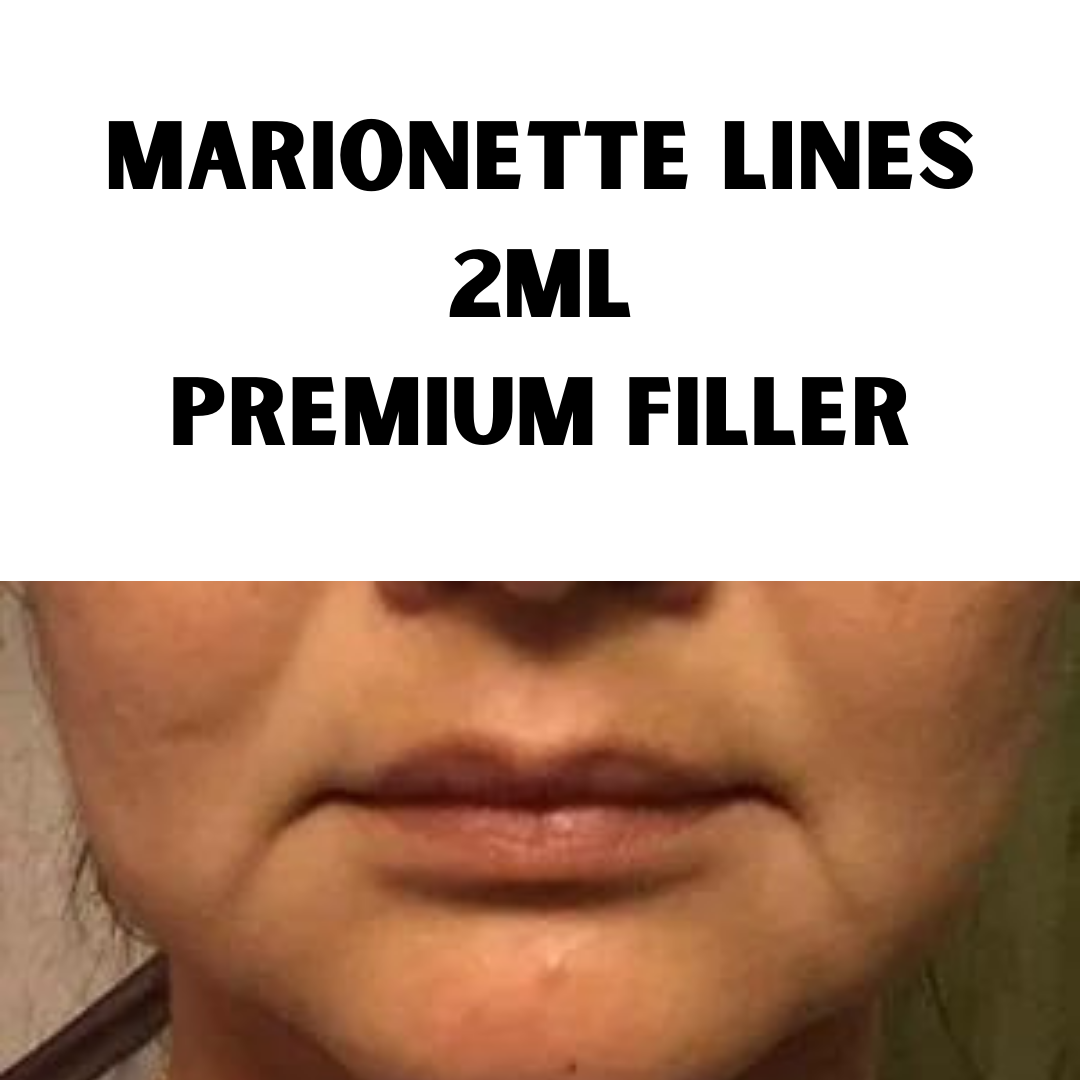 Marionette line Filler. Premium 2ml