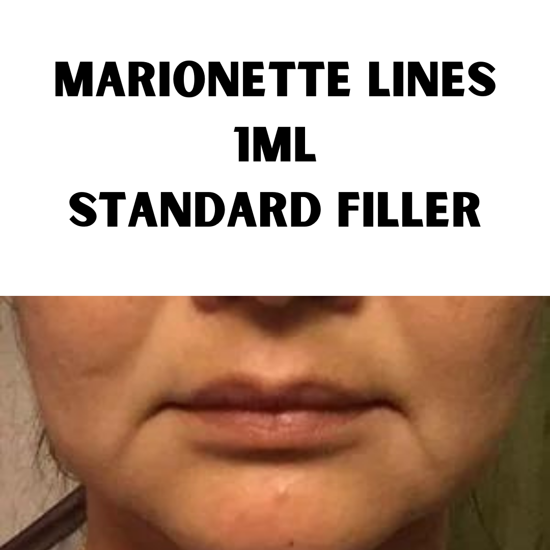 Marionette line Filler. Standard 1ml