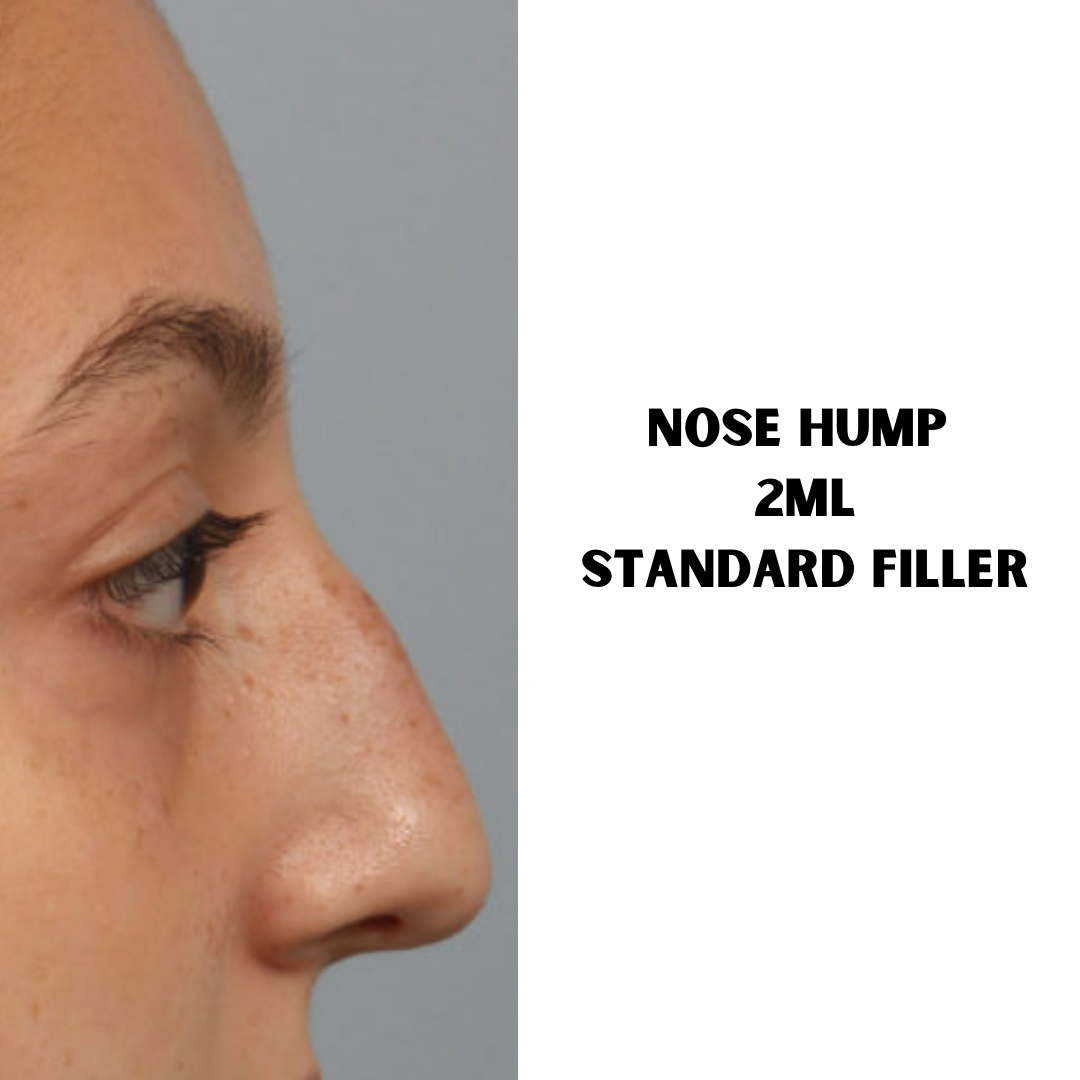 Nose Hump Filler. Standard 1ml