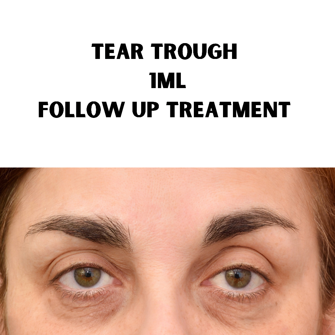 Tear Trough Filler. Redensity 1ml (Follow Up)