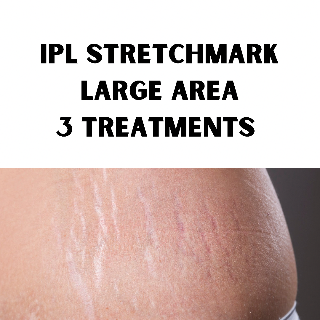 IPL Stetchmark Treatment (3 Treatments of Large area: 20 x 20cm)