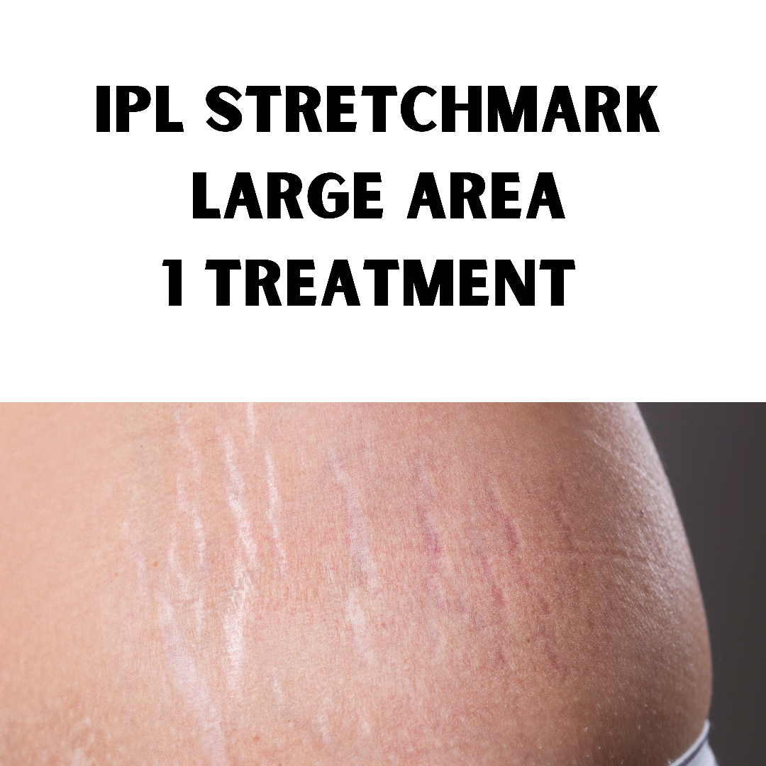 IPL Stetchmark Treatment (1 Treatment of Large area: 20 x 20cm)