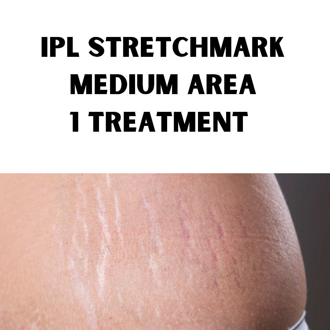 IPL Stetchmark Treatment (1 Treatment of medium area: 10 x 10cm)