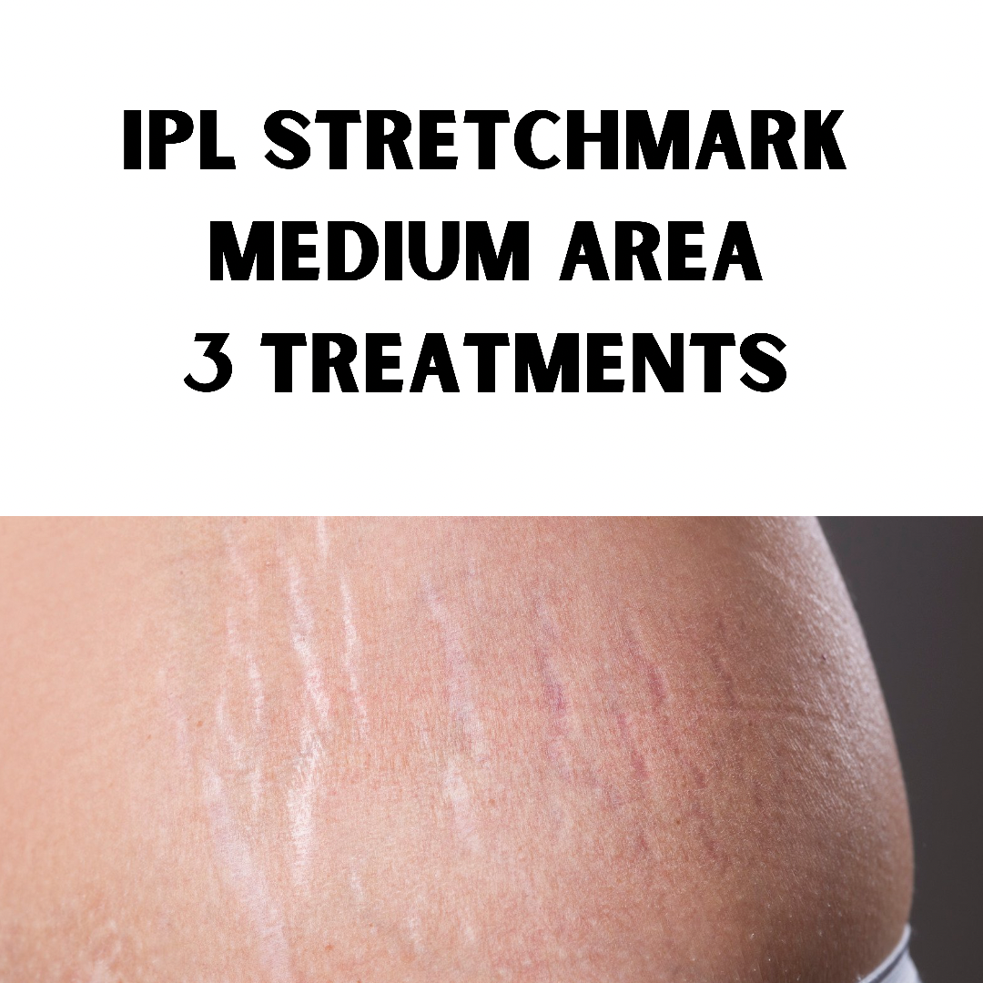 IPL Stetchmark Treatment (3 Treatments of medium area: 10 x 10cm)