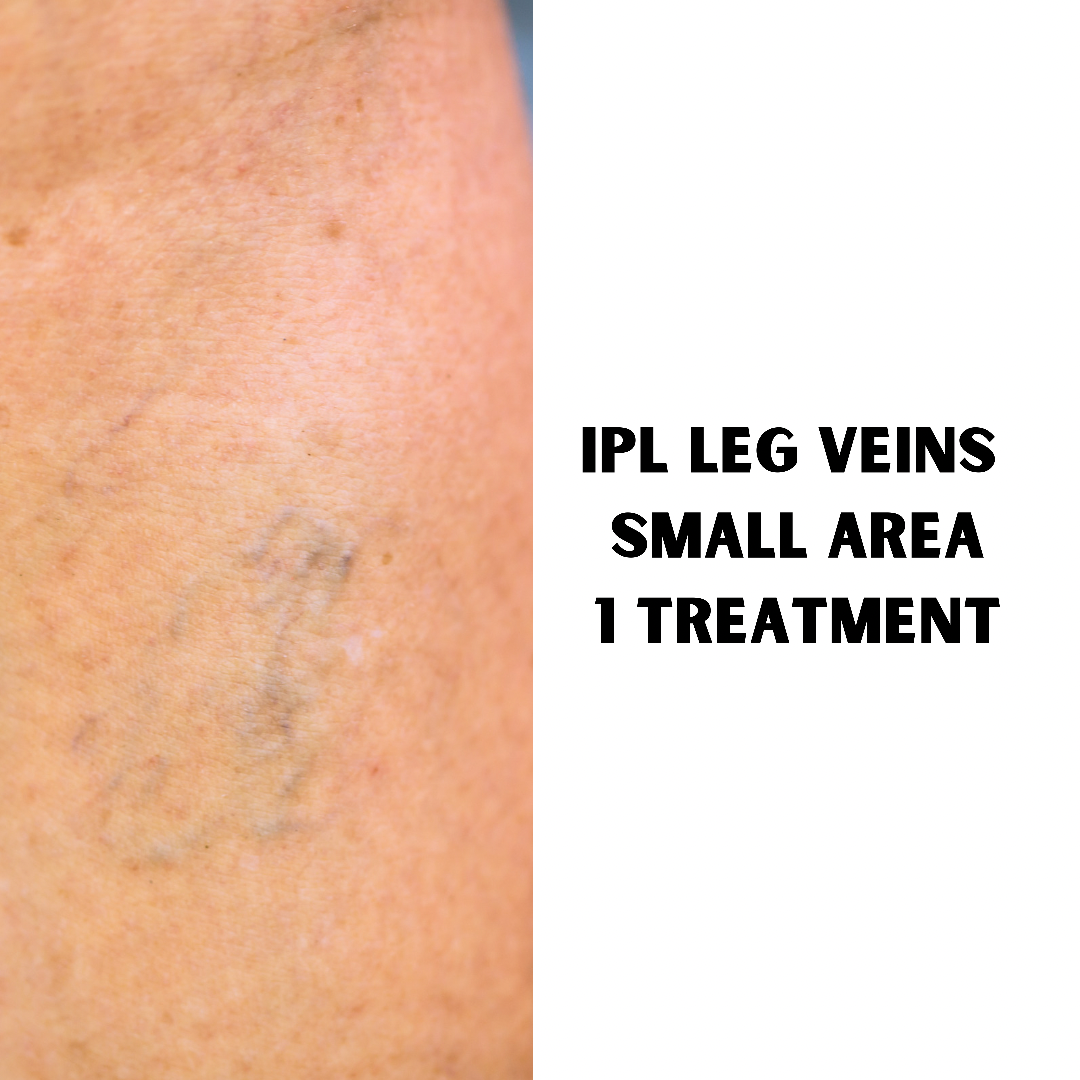 IPL Thread Vein Treatment (1 Treatment of small area: 5 x 5cm)