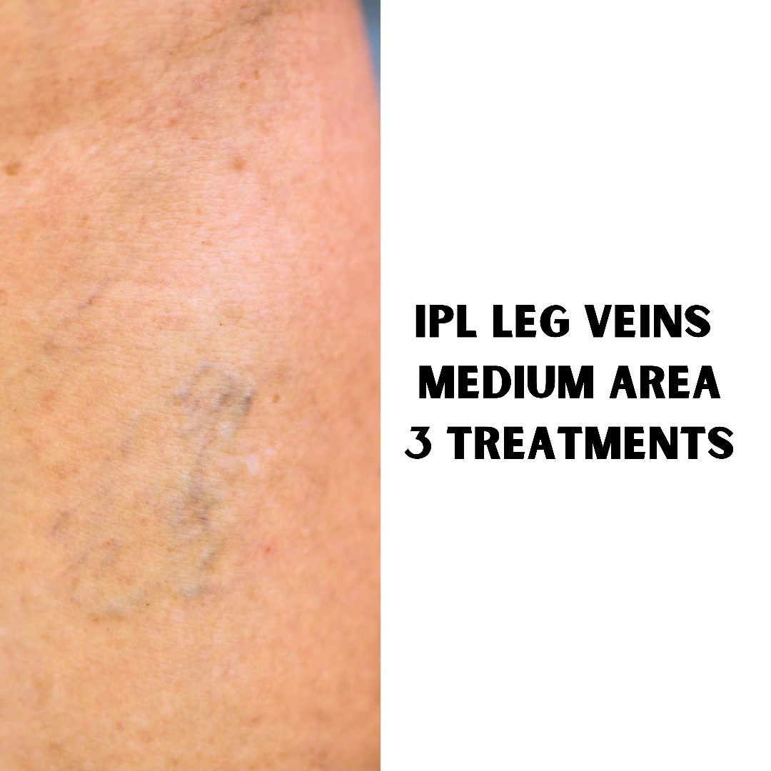IPL Thread Vein Treatment (3 Treatments of medium area: 10 x 10cm)