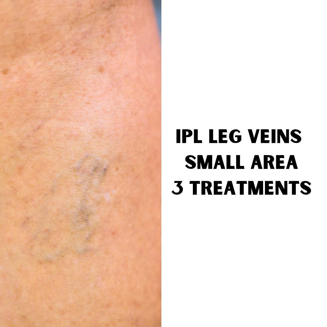 IPL Thread Vein Treatment (3 Treatments of small area: 5 x 5cm)