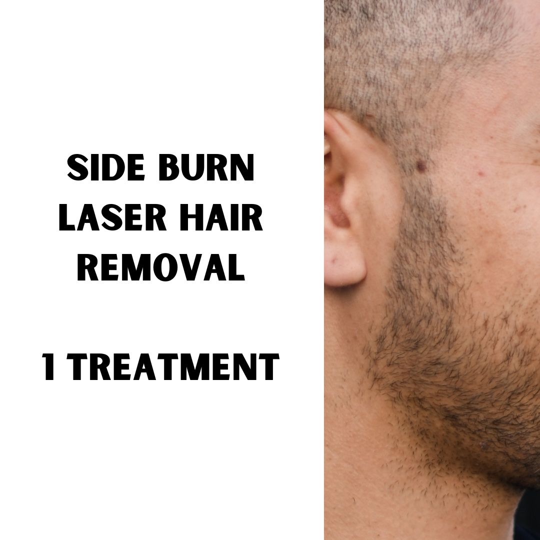 Side Burns Hair removal (1 treatment)