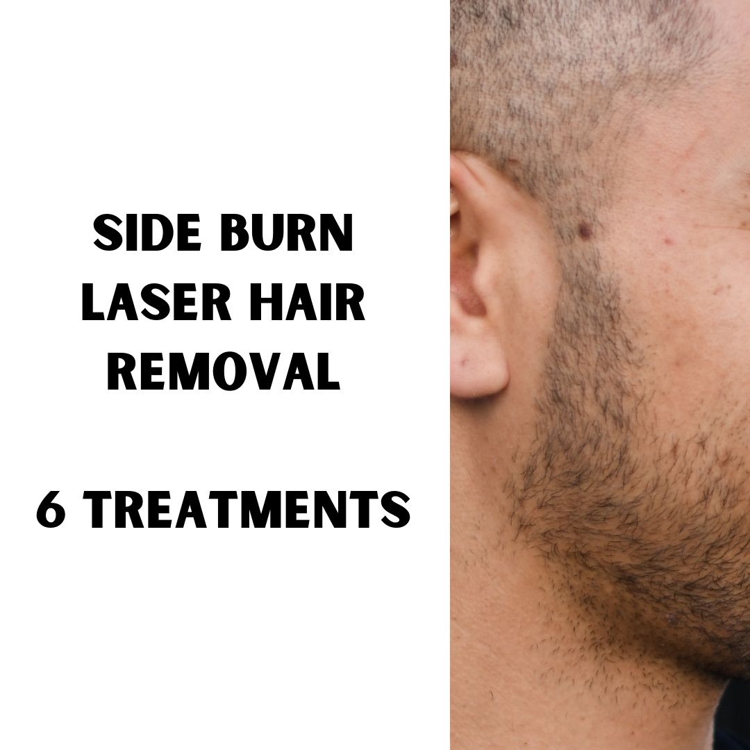 Side Burns Hair removal (6 treatments)