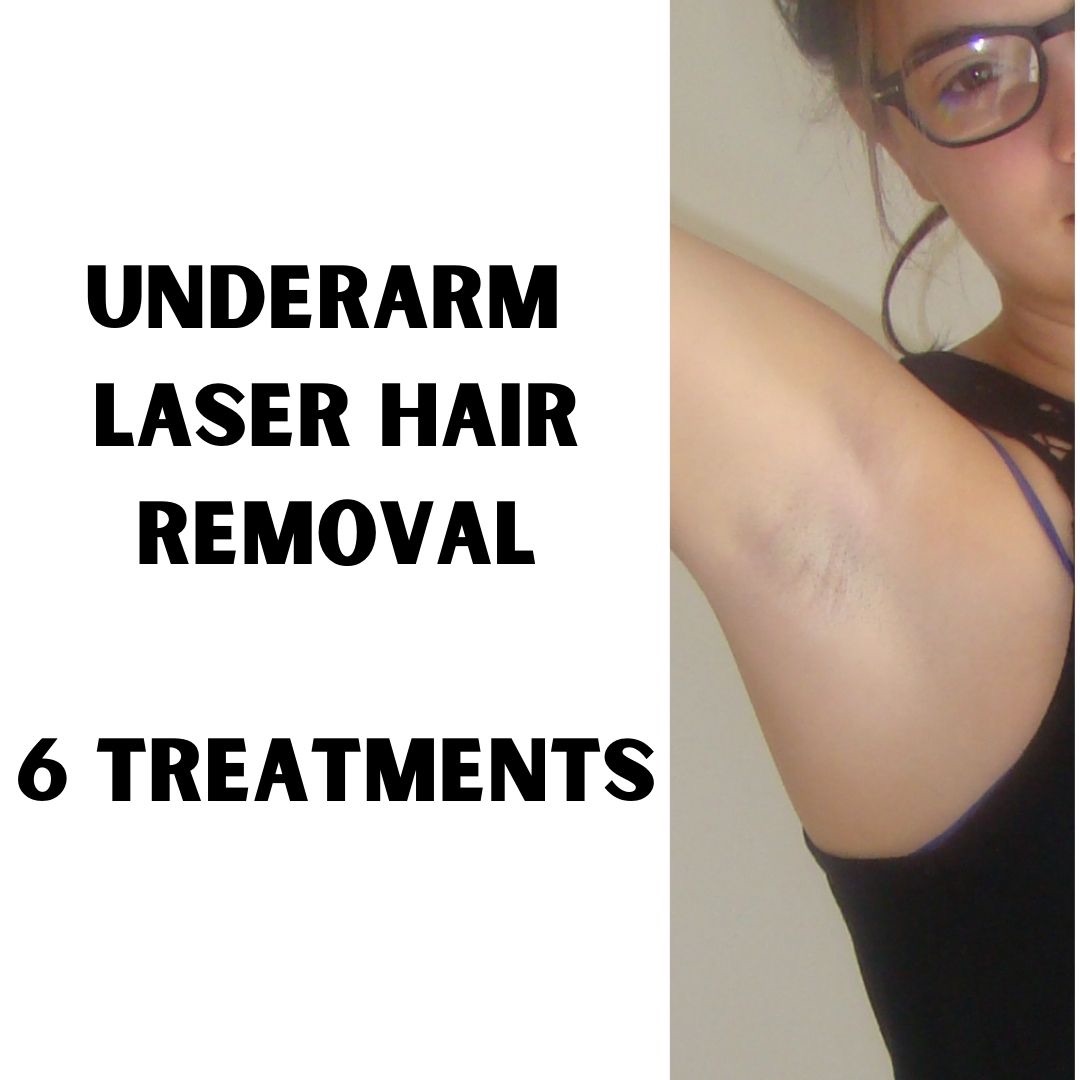 Under Arm Hair removal (6 treatments)