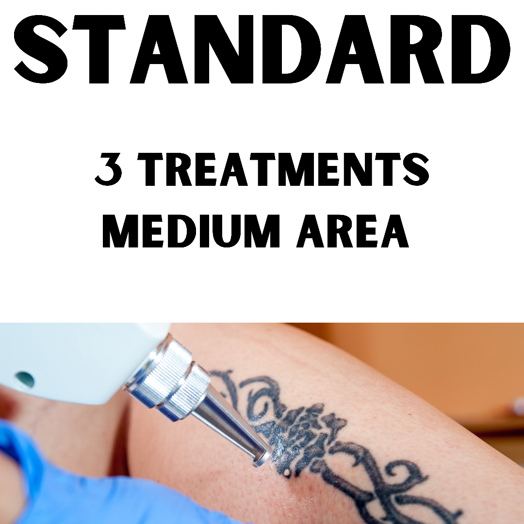 Standard Laser Tattoo Removal (3 Treatments medium area, 12 x 12cm)