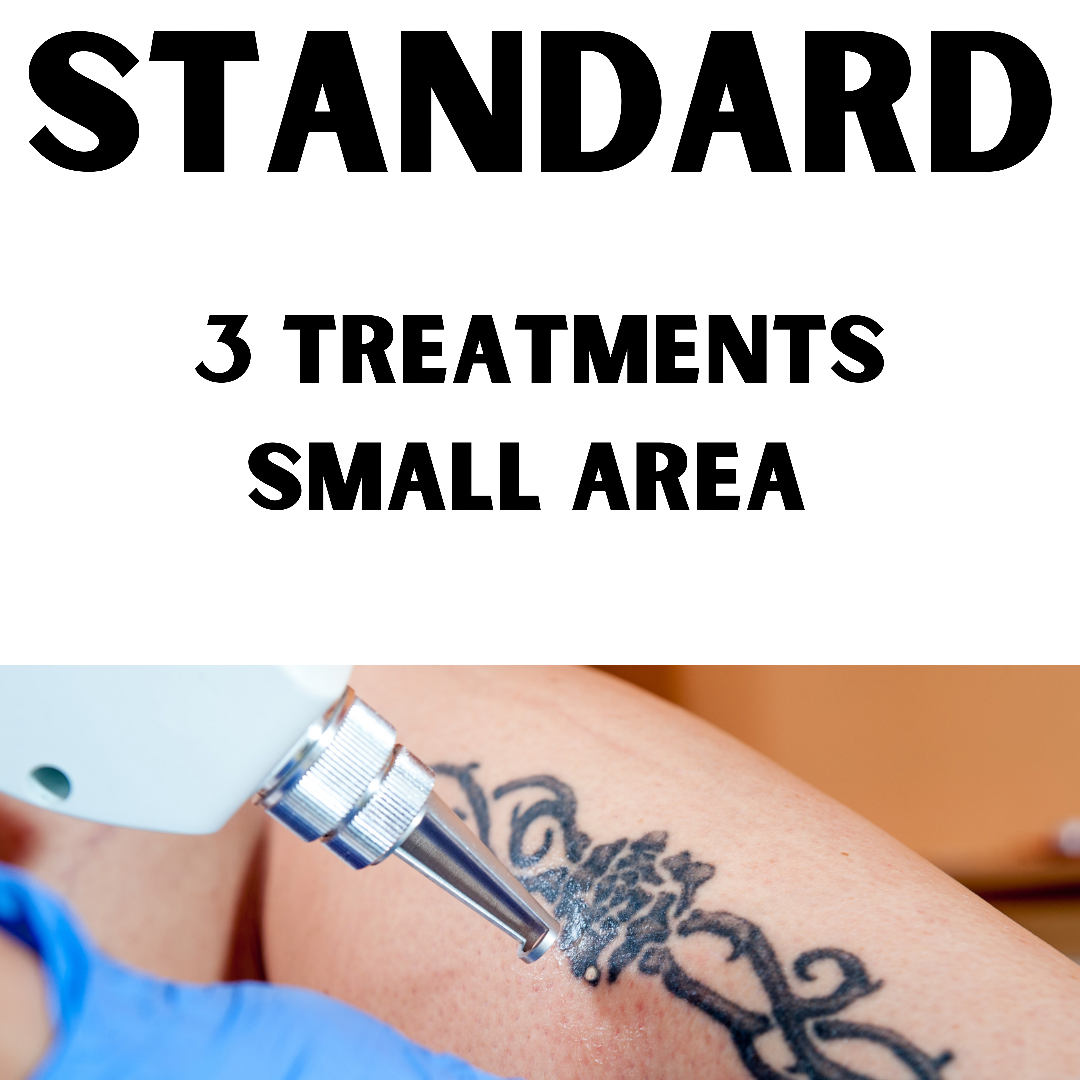 Standard Laser Tattoo Removal (3 x Treatments small area, 6 x 6 cm)