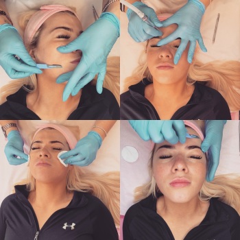 Microdermabrasion Facial 