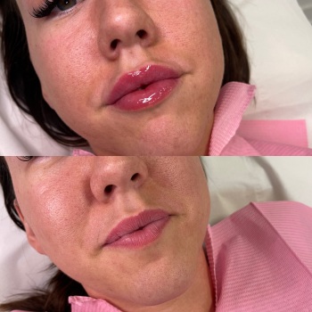 Foundation Dermal Filler