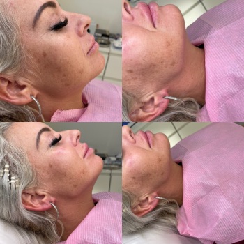 Advanced Dermal Filler Course