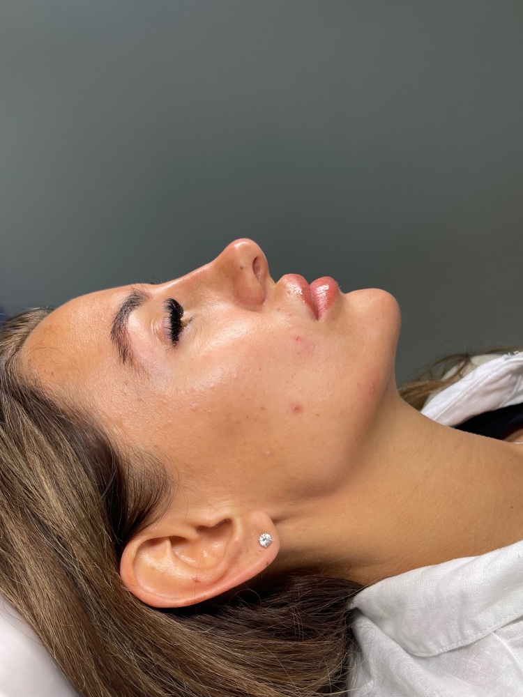 Advanced Rhinoplasty and Tear Trough Course
