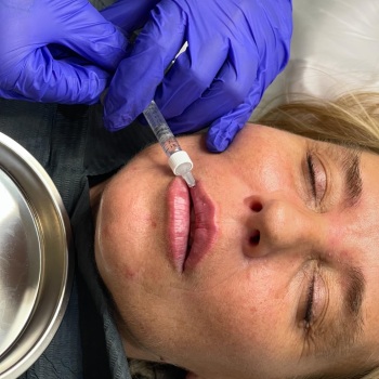 Foundation Dermal Filler