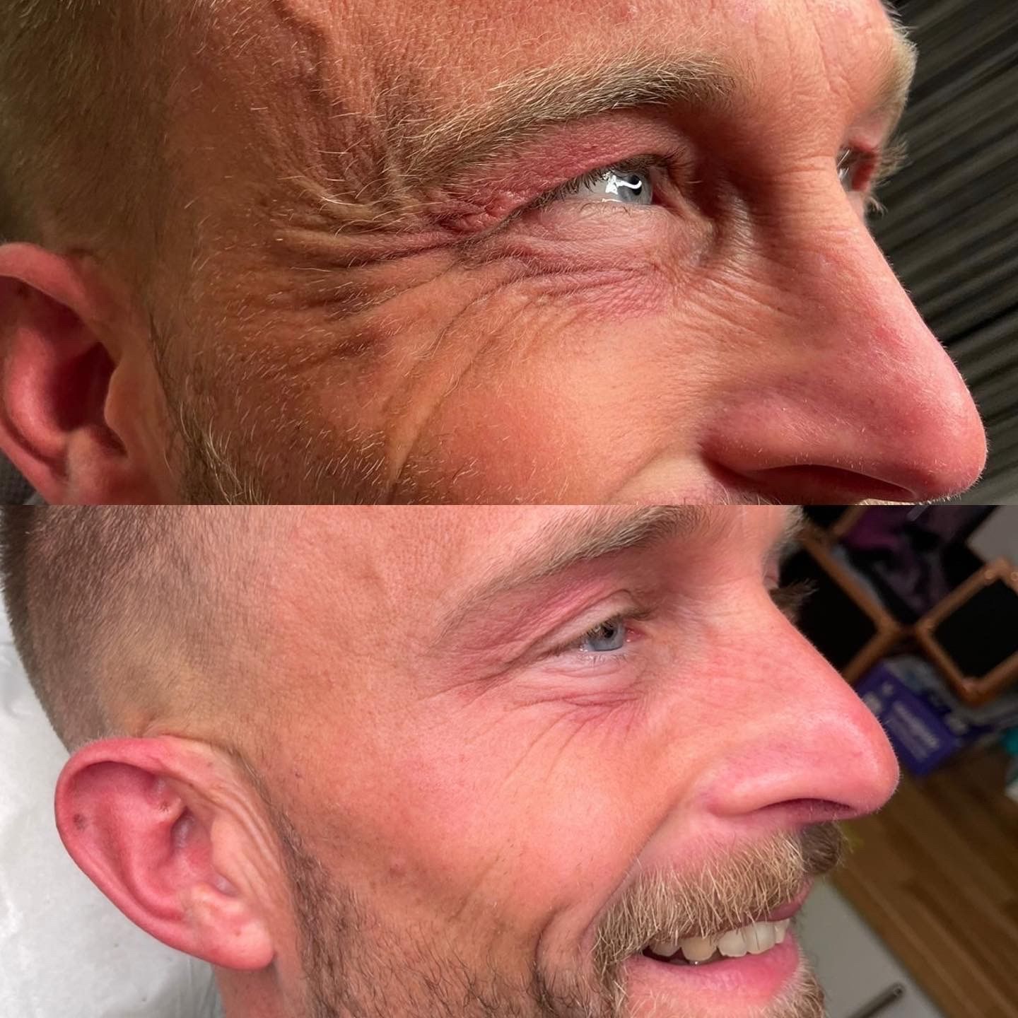 male botox before and after