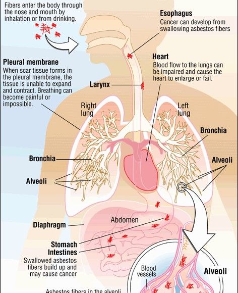 Asbestos related diseases 2